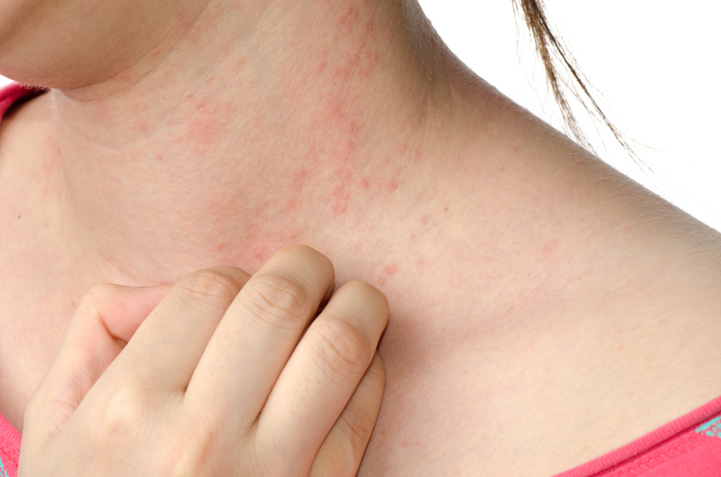 Eczema | cause and cure