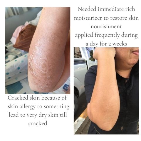 Cracked skin need immediate rich moisturizer