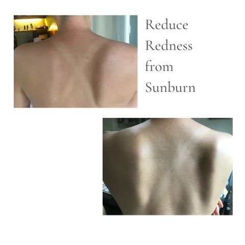 Reduce Redness from Sunburn